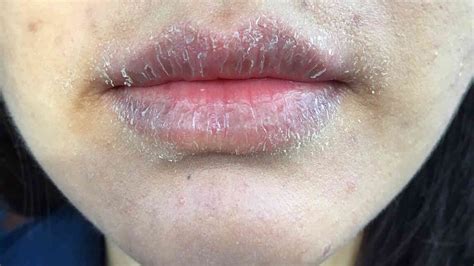 allergic reaction to lips pictures